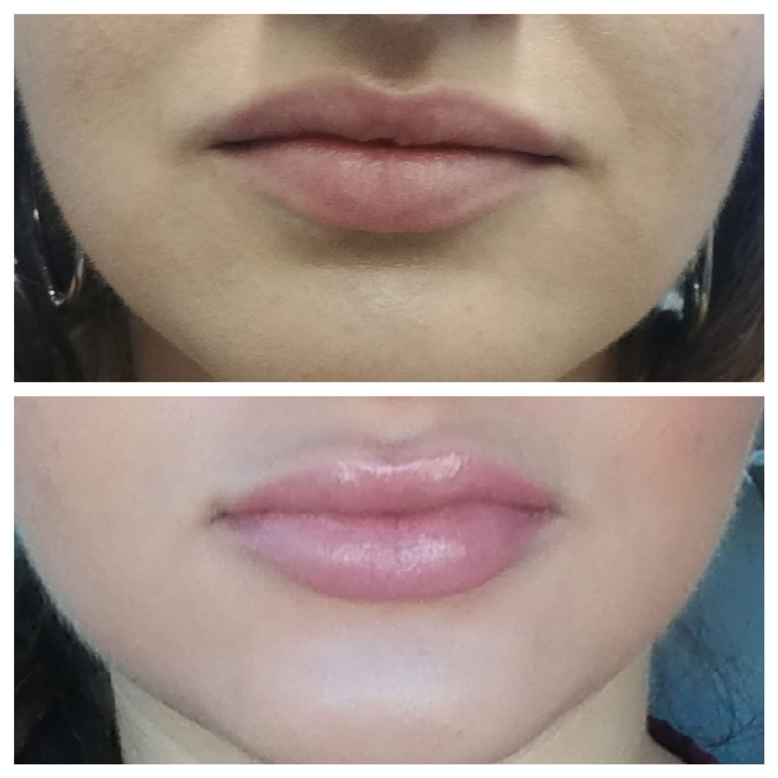 Lip Filler Injections 5 Things To Know Denver Laser Solutions